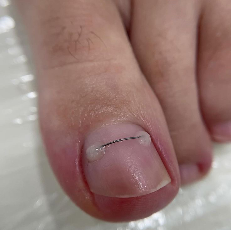 Обработка вросшего ногтя