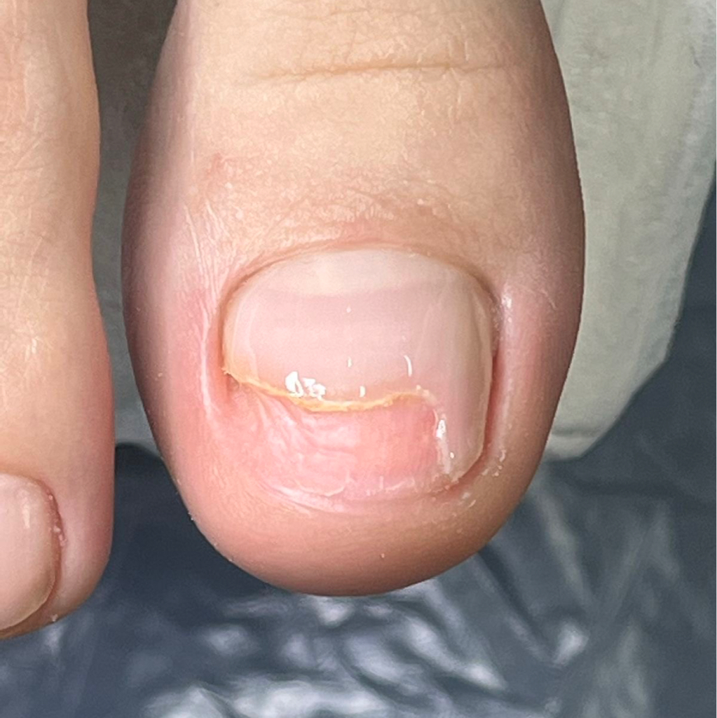 Зачистка онихолизиса (1 ноготь)