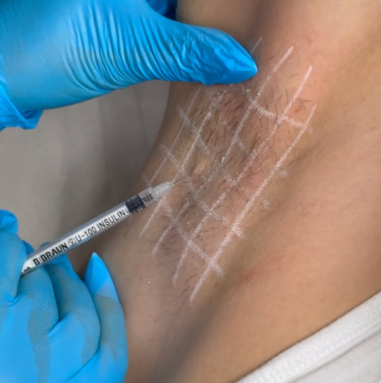 Гипергироз подмышек