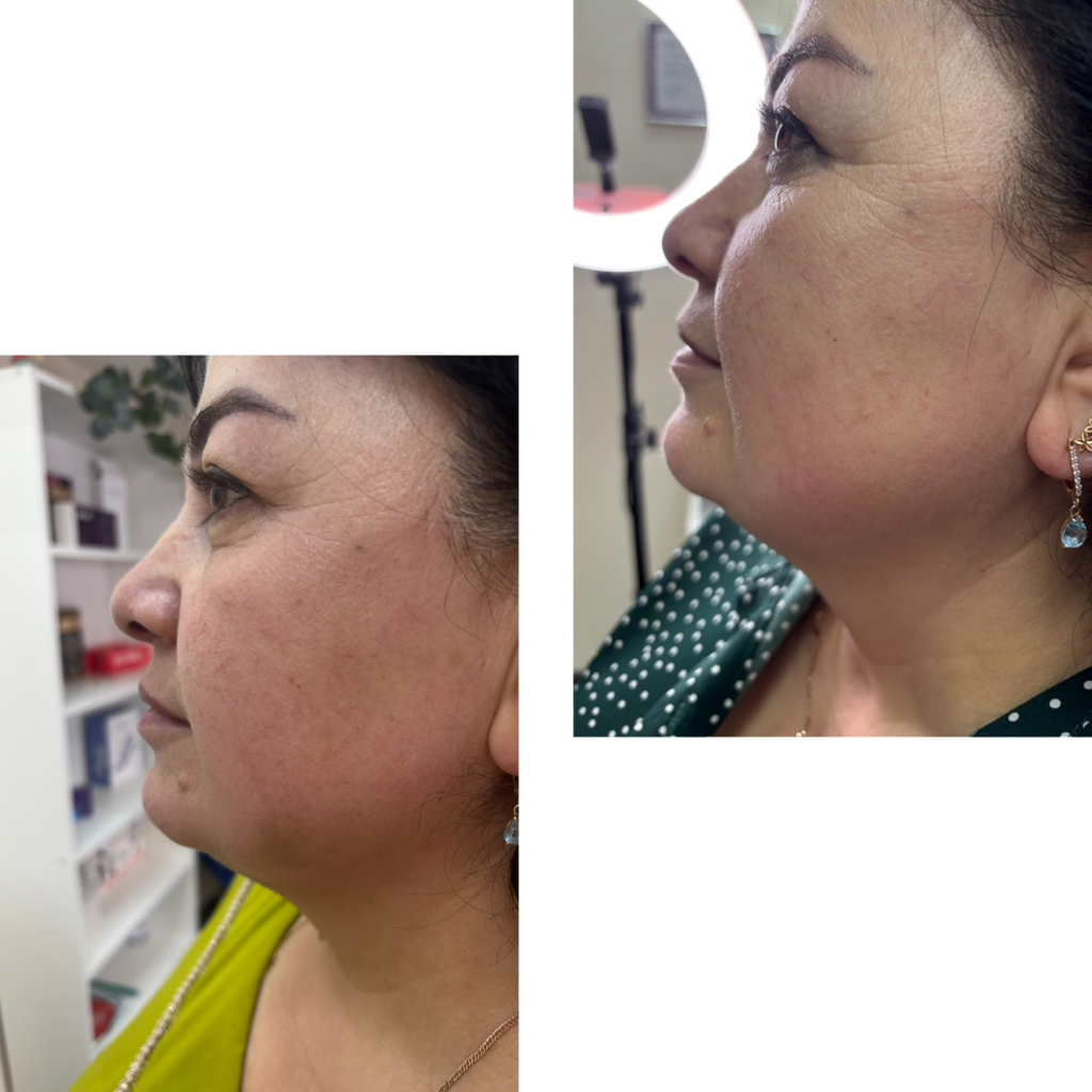 Липолитики Стройность