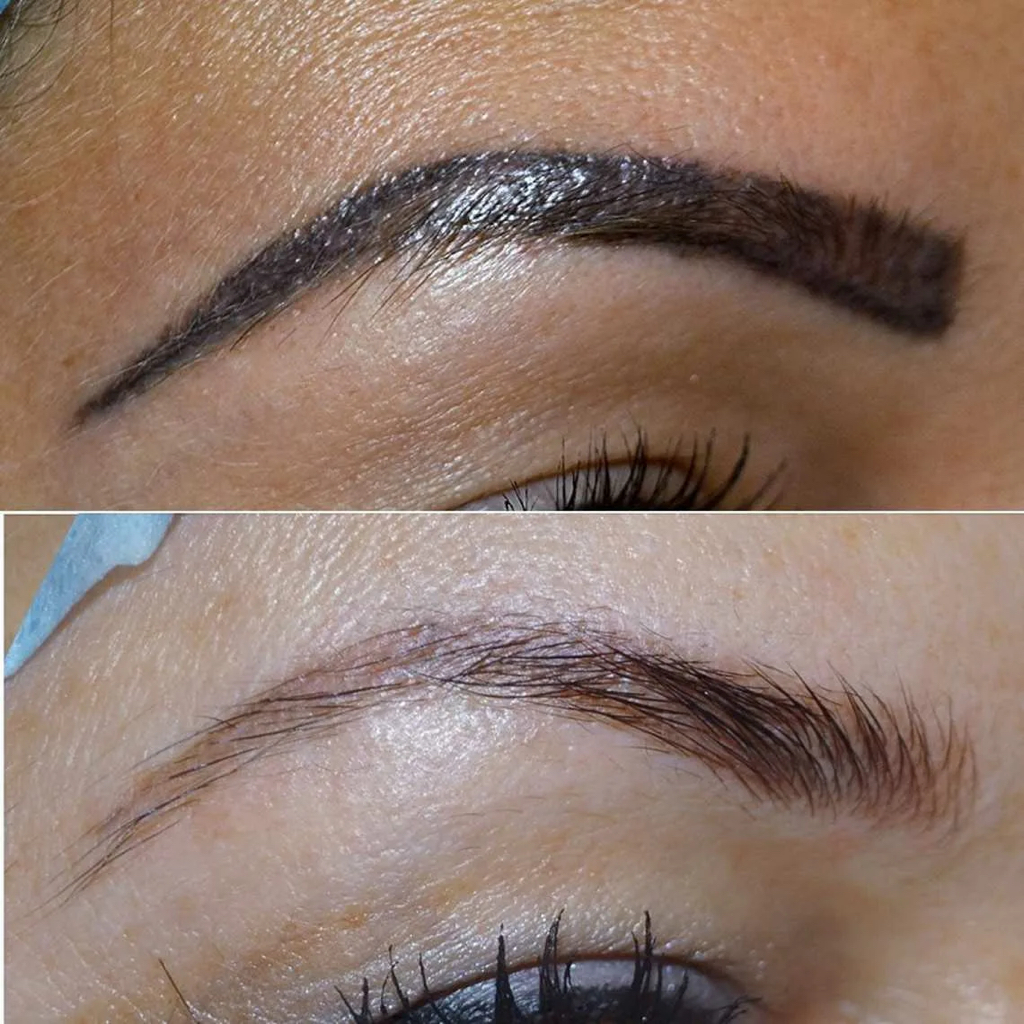 Сведение татуажа. Ремувер.