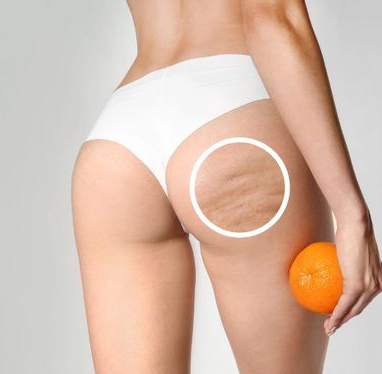 Курс Антицеллюлитного массажа 5 процедур