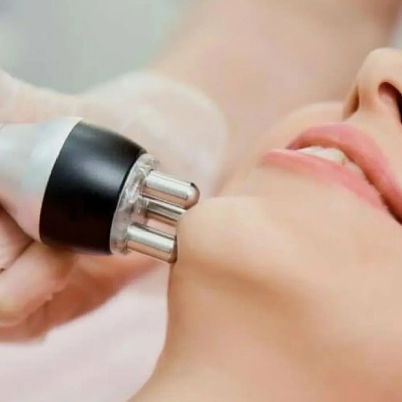 RF  лифтинг лица, шеи, декольте