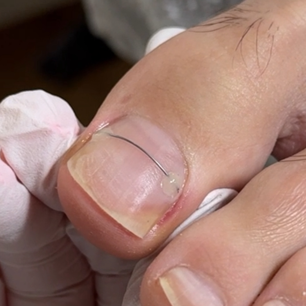 Correction system 1 nail