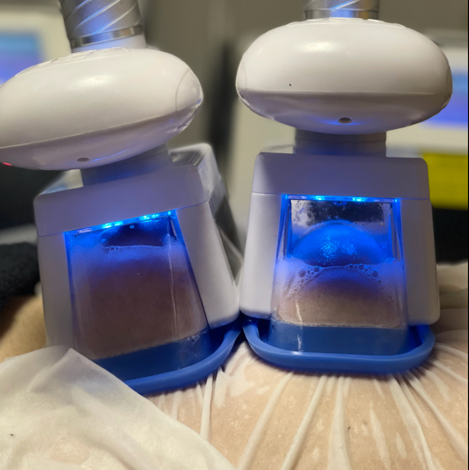 Криолиполиз 1 зона