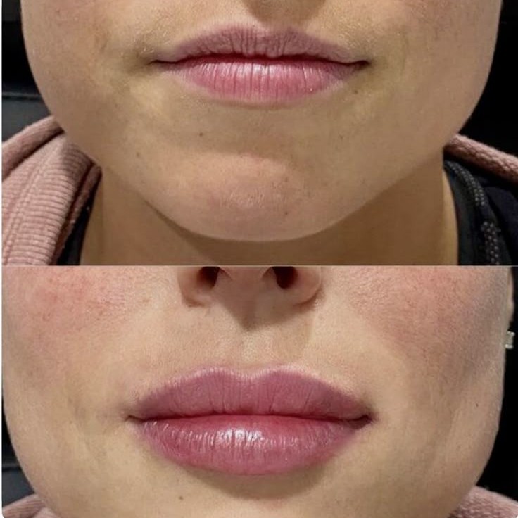 Аугментация губ