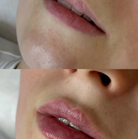 Биоревитализация губ