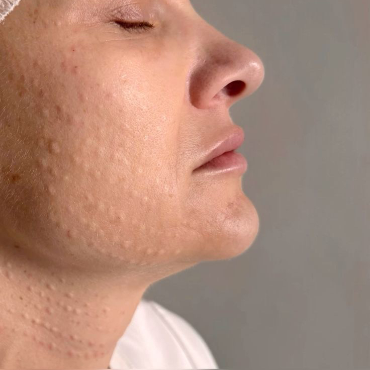 Биоревитализация лицо, шея, декольте