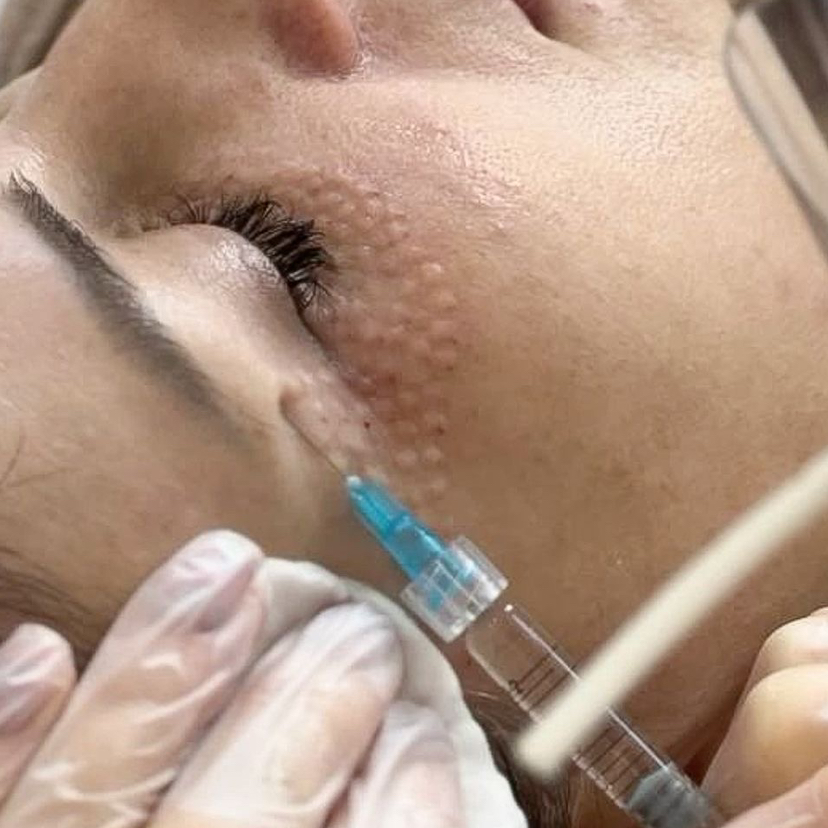 Мезотерапия периорбитальной зоны