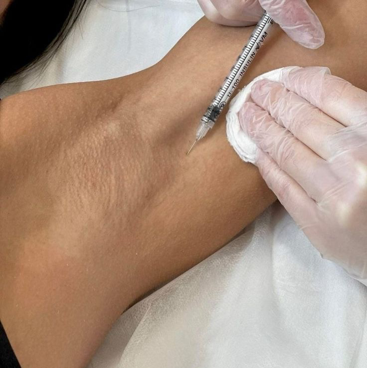 Гипергидроз