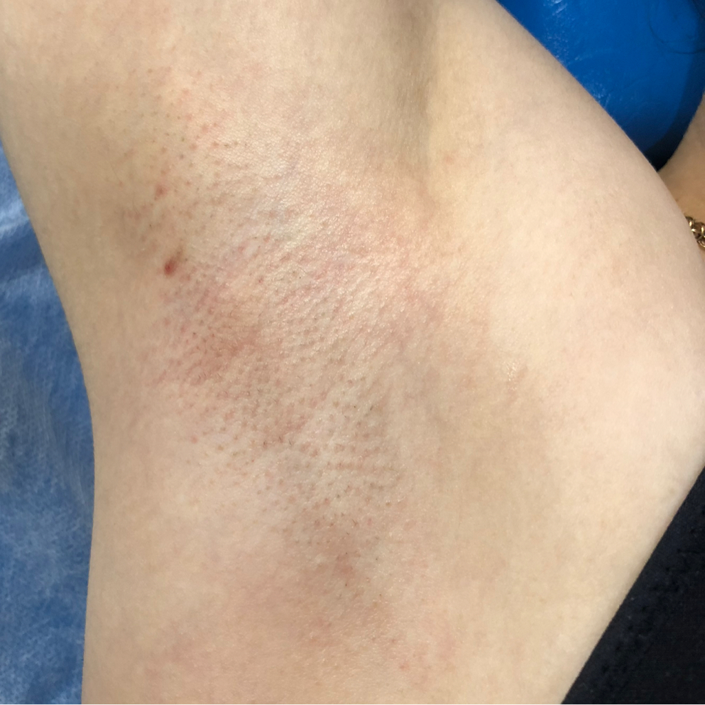 Бикини + подмышки + ручки