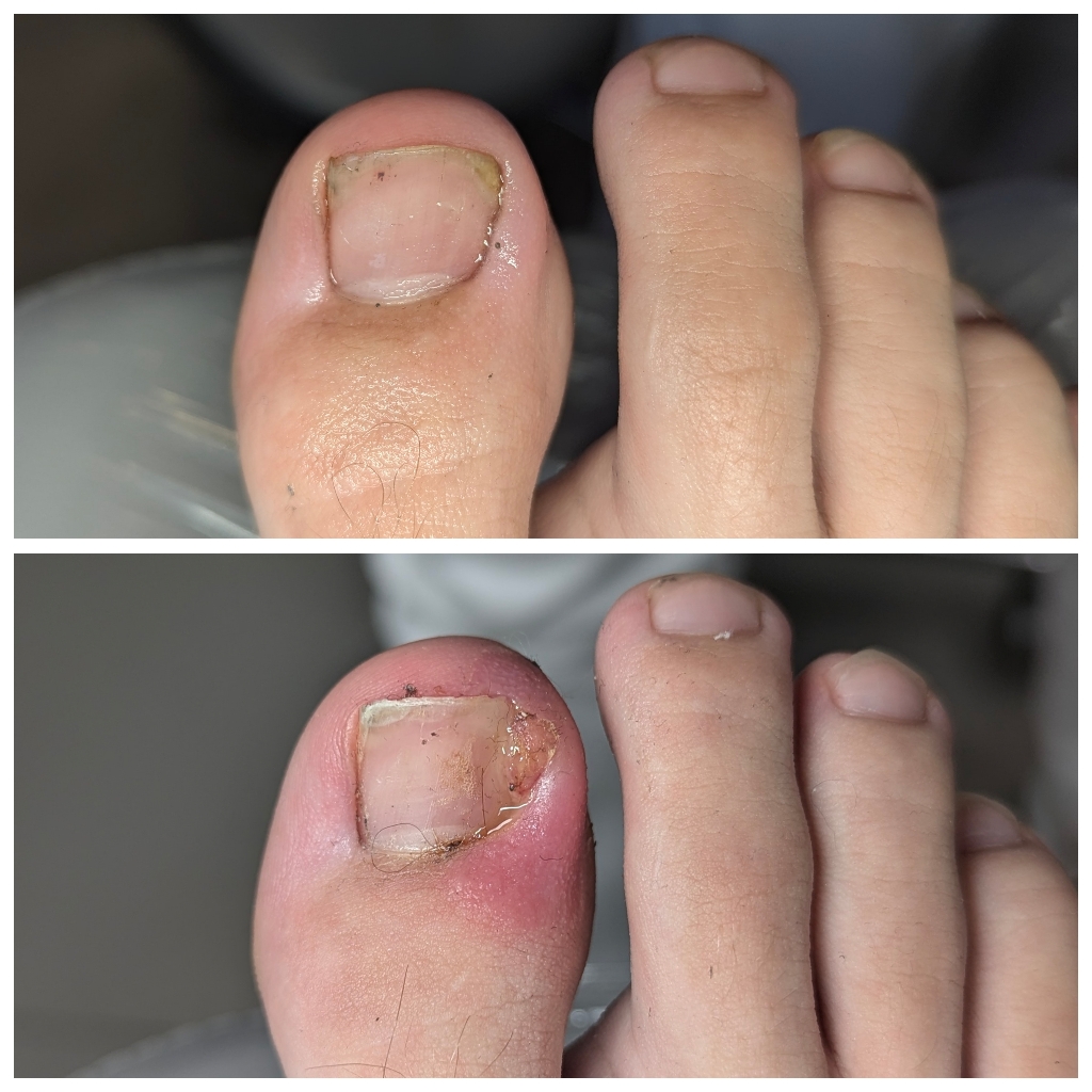 Обработка вросшего ногтя : повторный прием.