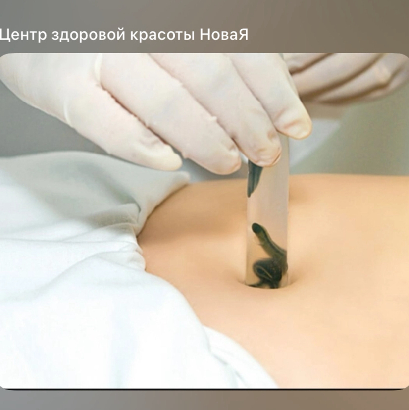 Постановка пиявок