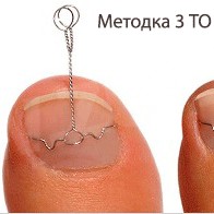 Установка 1(одной)скобы на большие пальцы