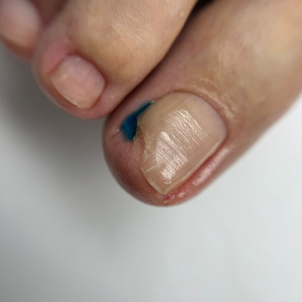 Установка тампонады, услуга оказывается только совместно с педикюром или обработкой пальчиков