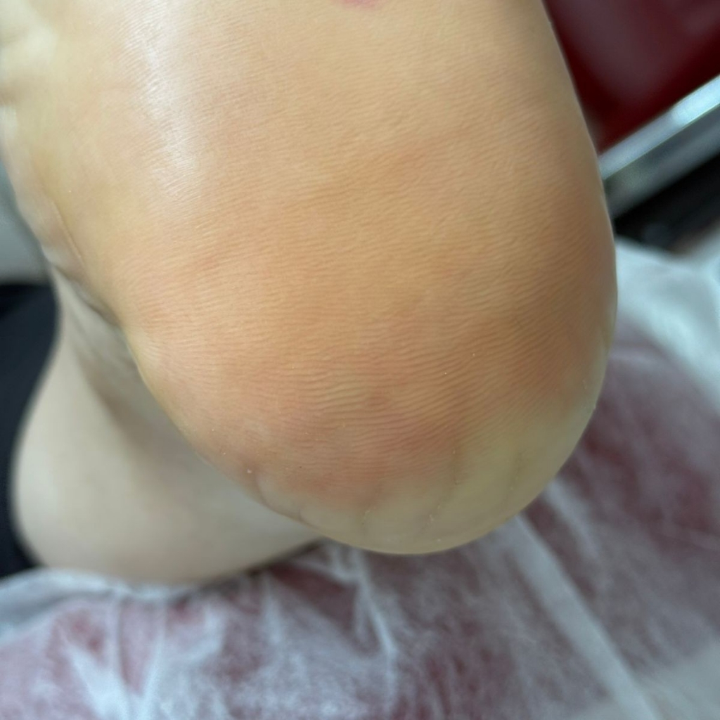 Обработка стоп и ногтей 2 степени (трещины, мазоли, зачистка ногтей без инфекций)