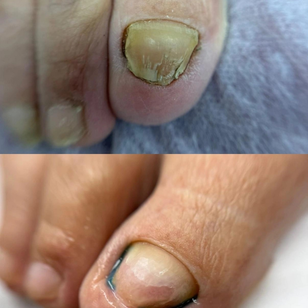 Обработка ногтей и стоп 3 степени (грибковое поражение, синегнойная палочка, диабетическая стопа, глубокие трещины)