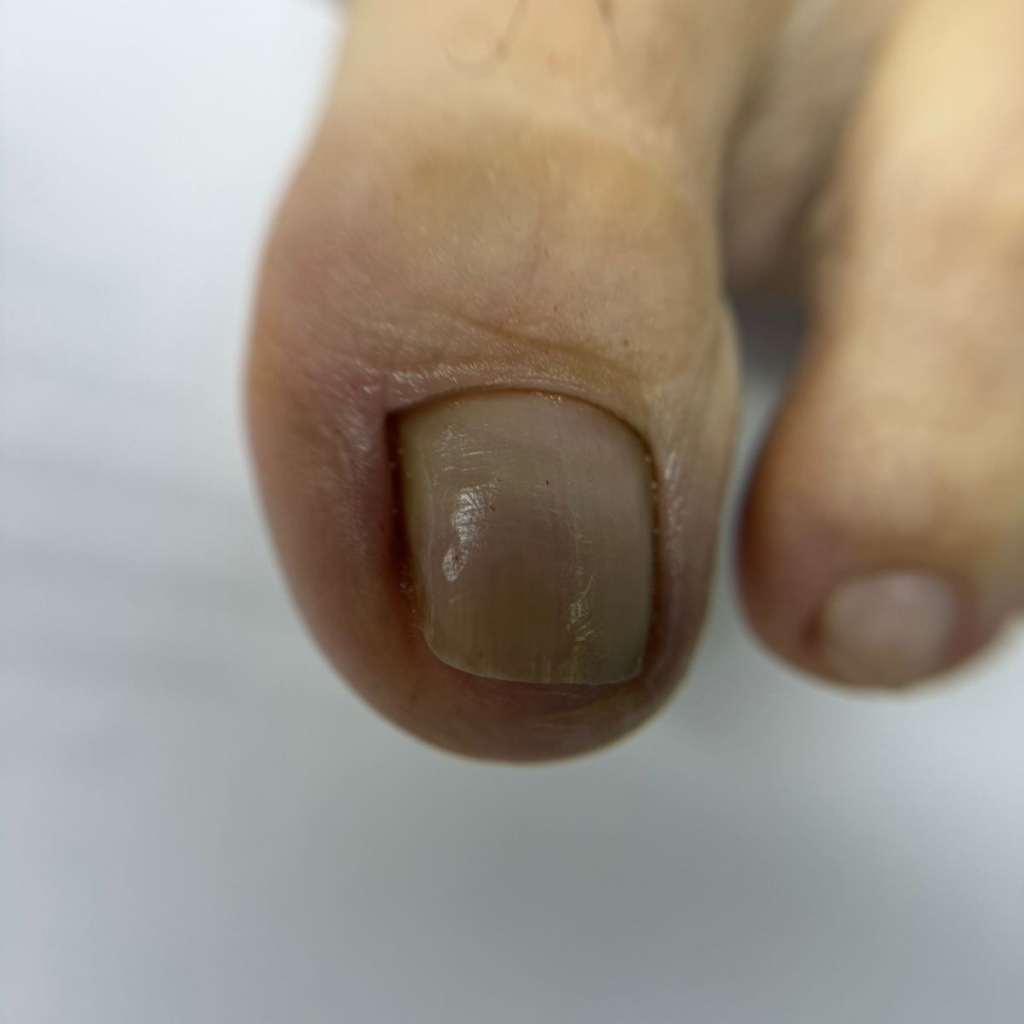 Обработка ногтей и стоп  1 степени (стопа и ногти без осложнений, тампонада)