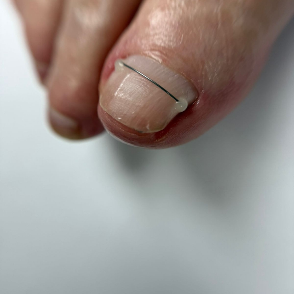 Установка титановой нити, услуга оказывается только совместно с педикюром или обработкой пальчиков