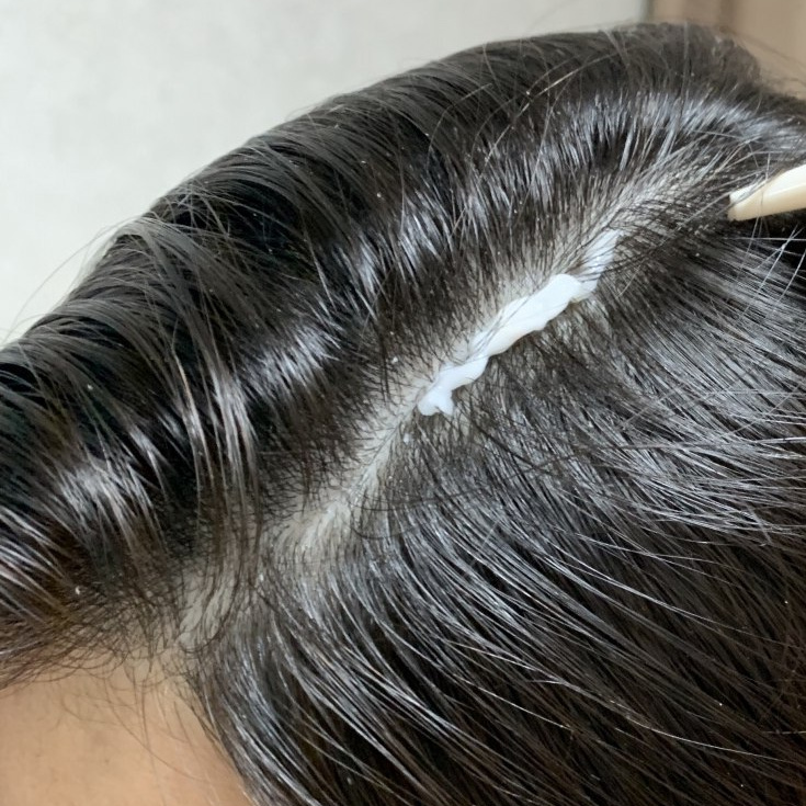 Пилинг кожи головы