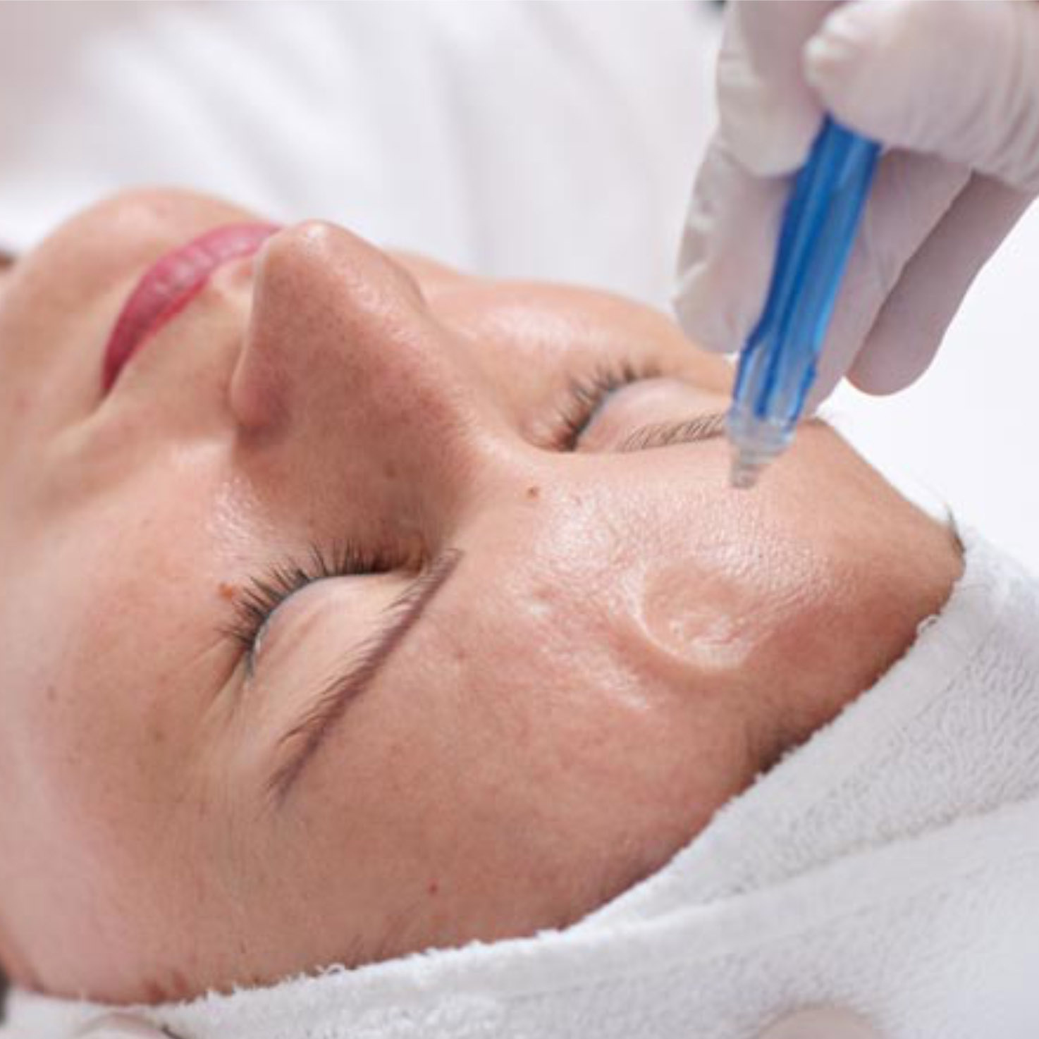 Газожидкостный пилинг лица , шеи , декольте