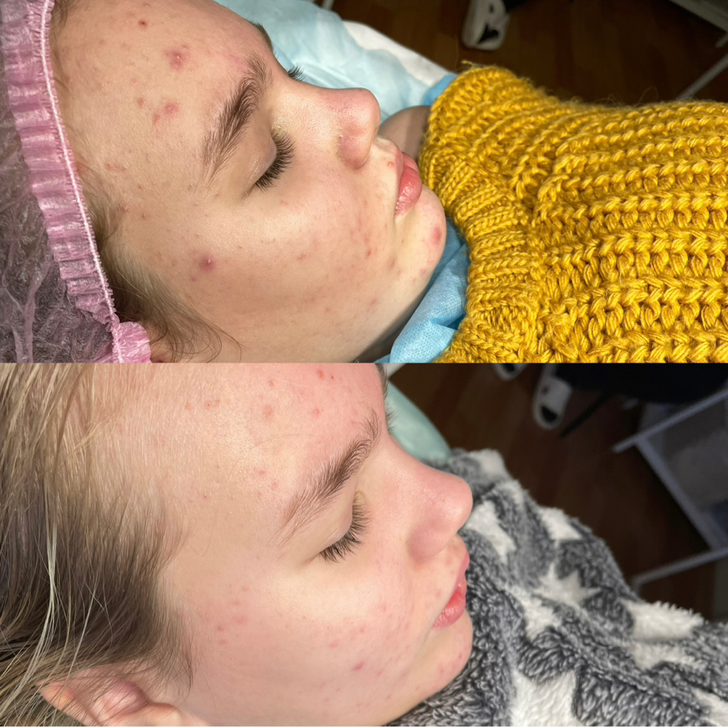 Авторская чистка лица