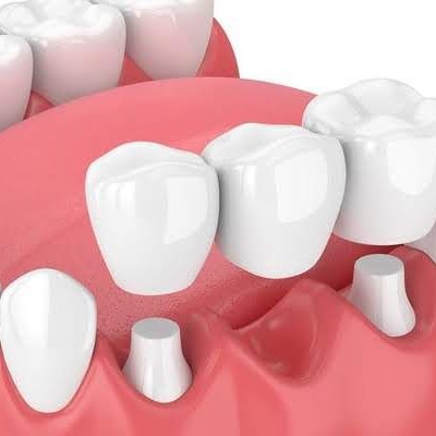 Установка мостовидного протеза