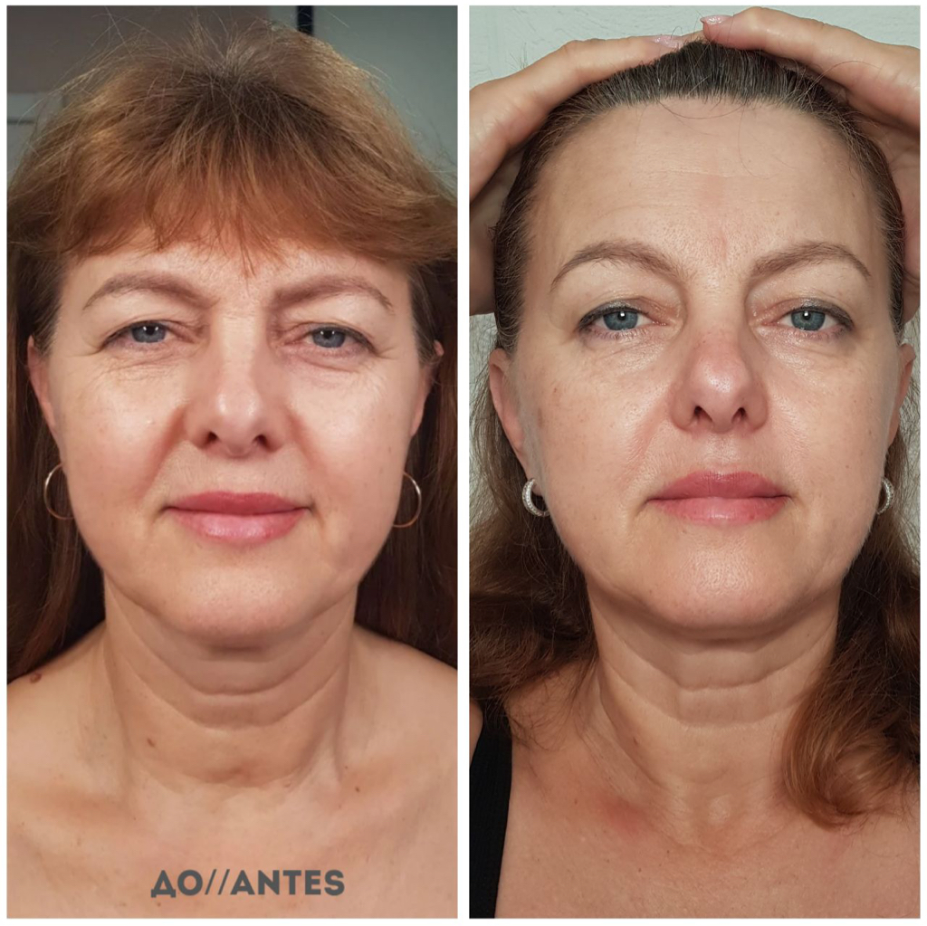 Masaje facial rejuvenecedor 1 sesión|| омолаживающий массаж лицо