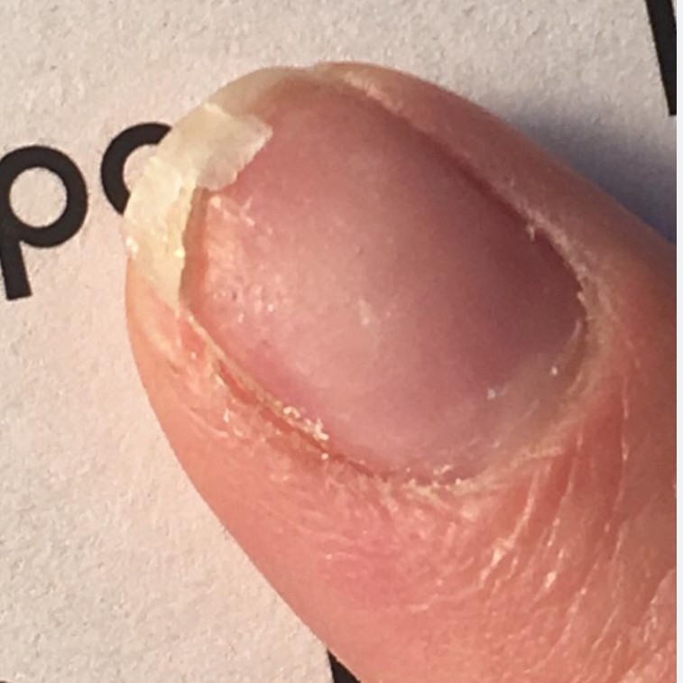 Ремонт ногтя