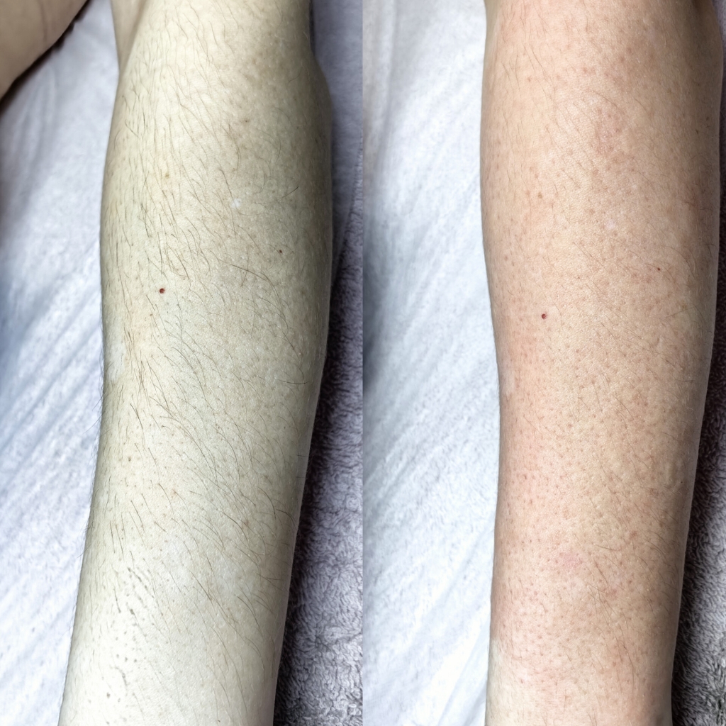 Электроэпиляция рук