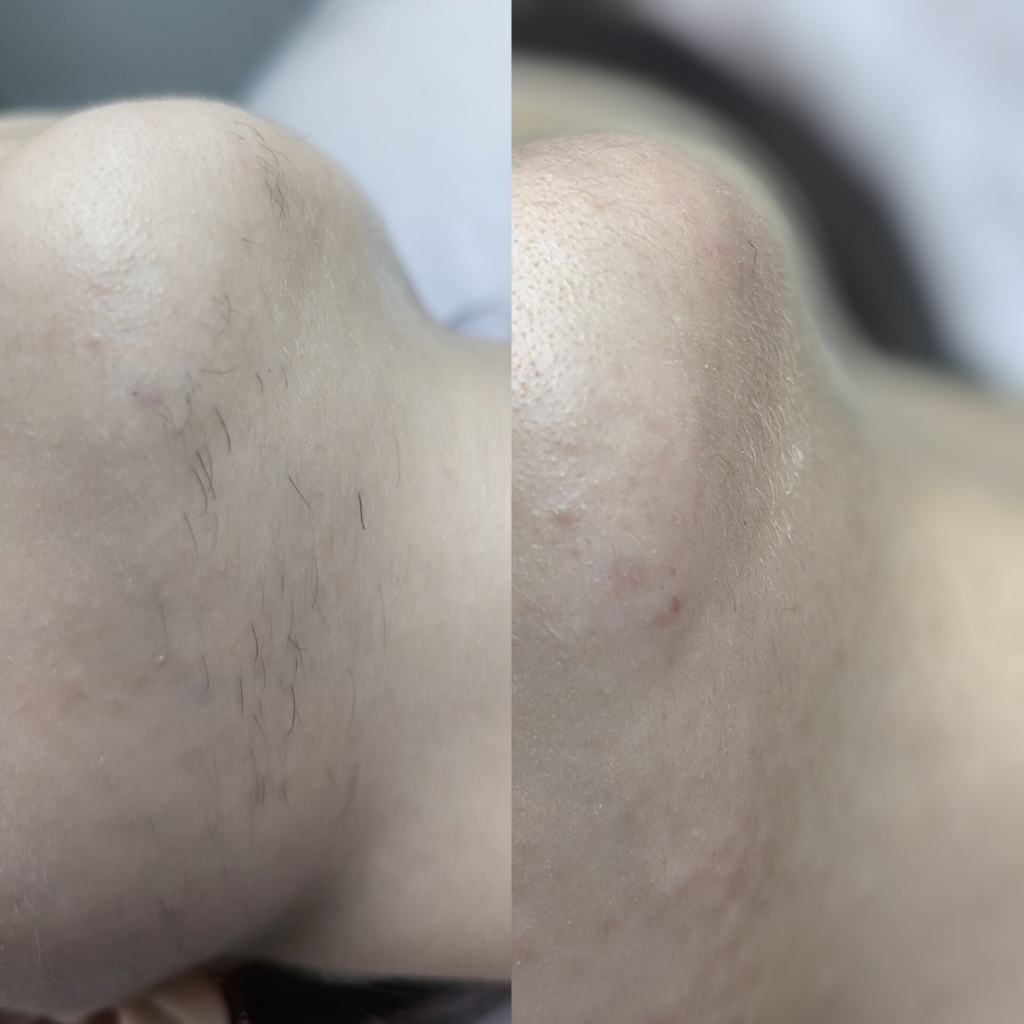 Электроэпиляция лица