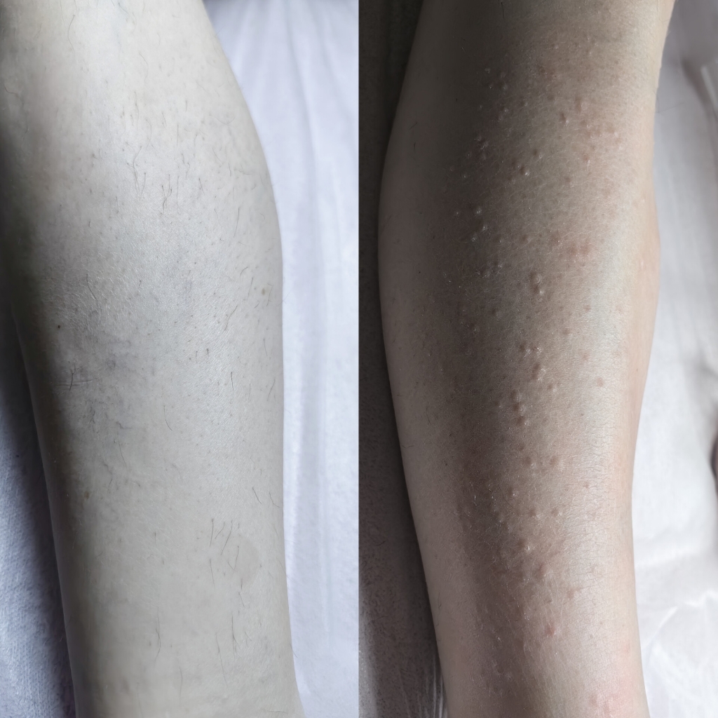 Электроэпиляция ног