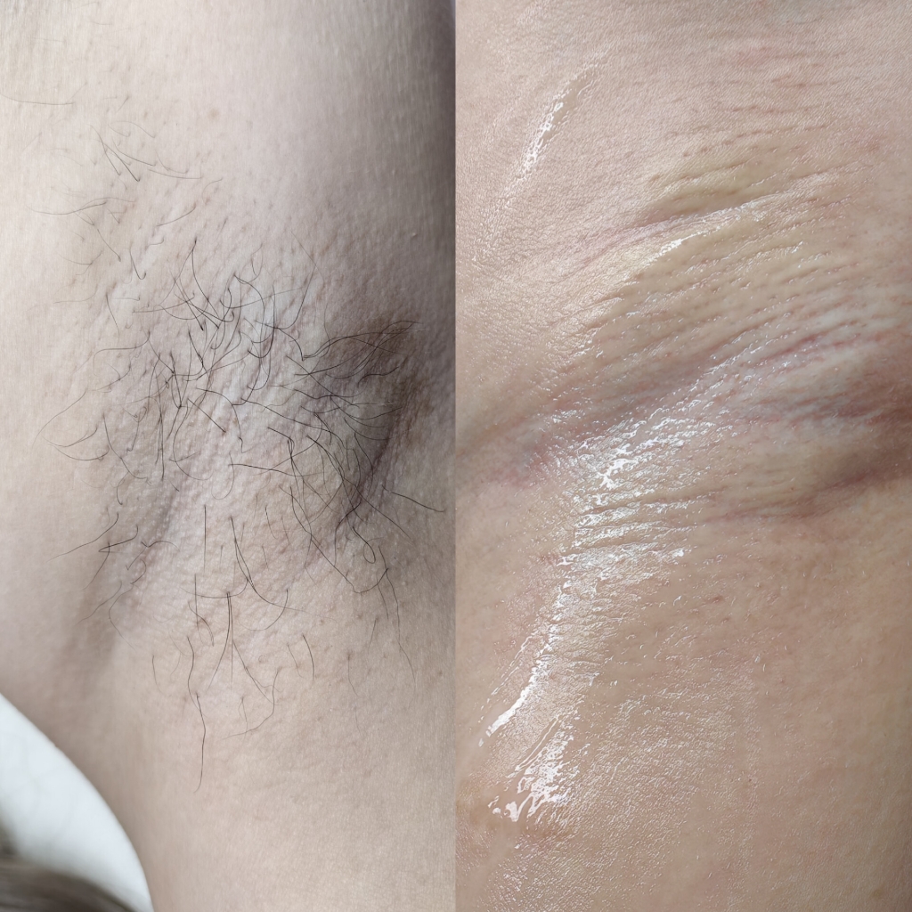 Электроэпиляция подмышечных впадин