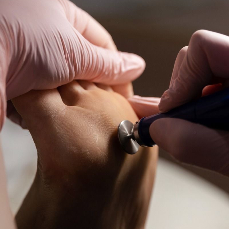 Мозоли /трещины/гиперкератоз/сложная стопа