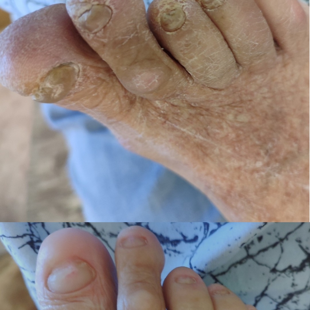 Педикюр при обработке утолщенных ногтей пожилым и маломобильным людям