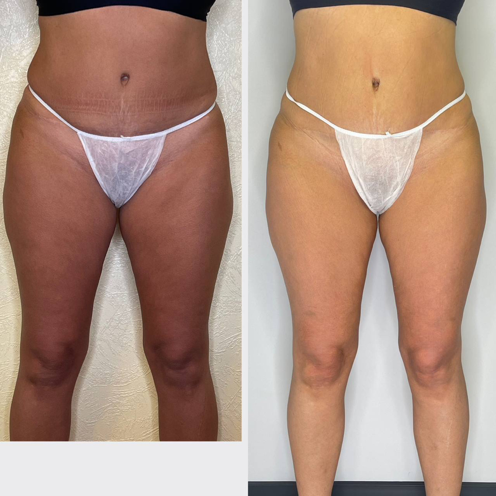 Лимфодренажный массаж