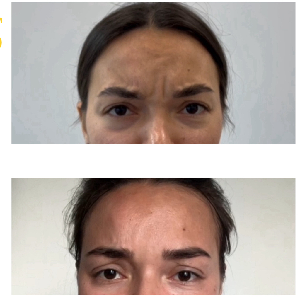 Профилактика морщин на лбу и межбровье РЕЛАТОКС