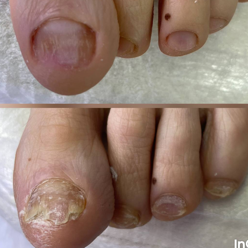 Обработка грибковых ногтей ежемесячная (без пяток)