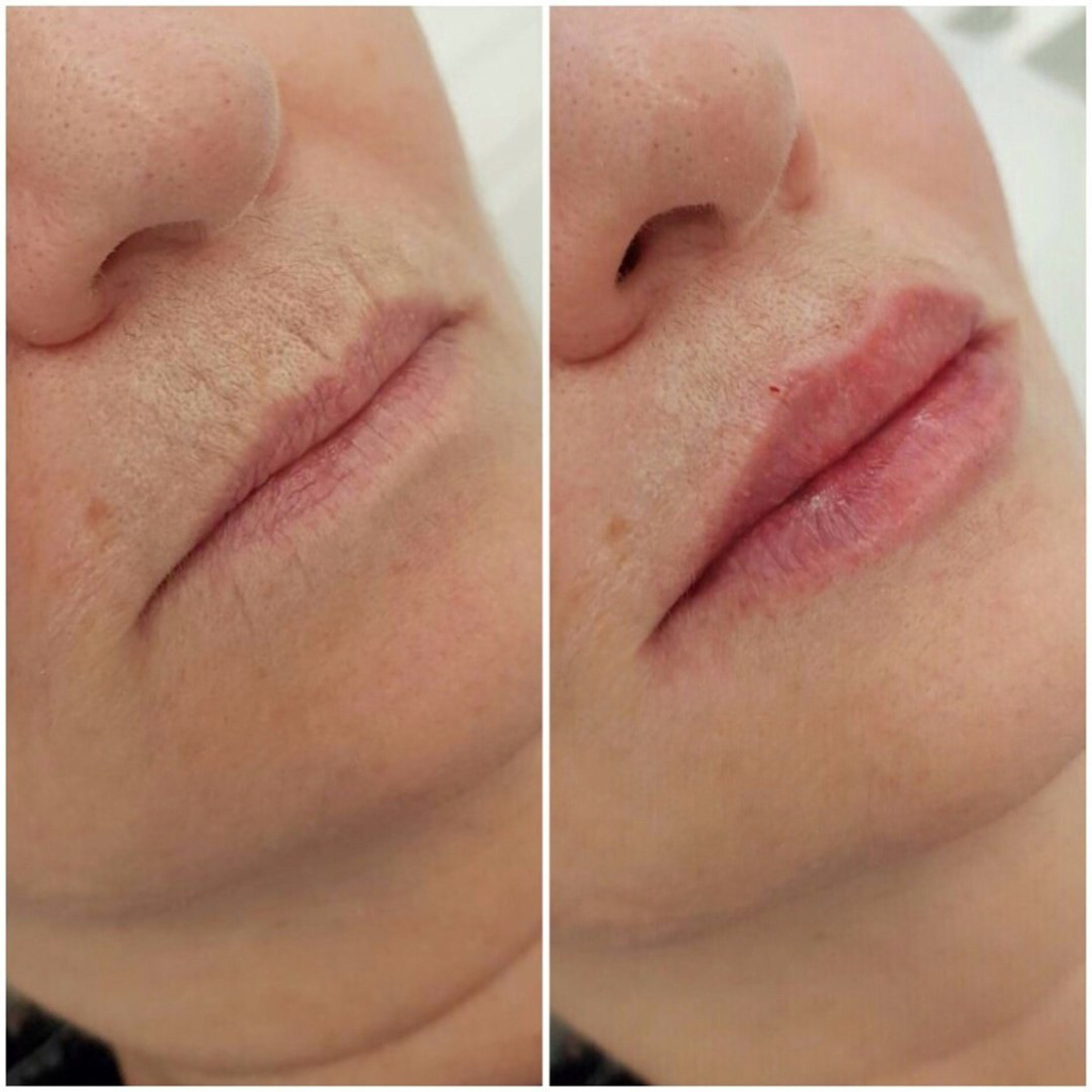 Заполнение кисетных морщин