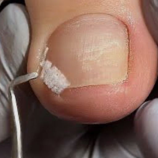 Тампонирование околоногтевый валиков