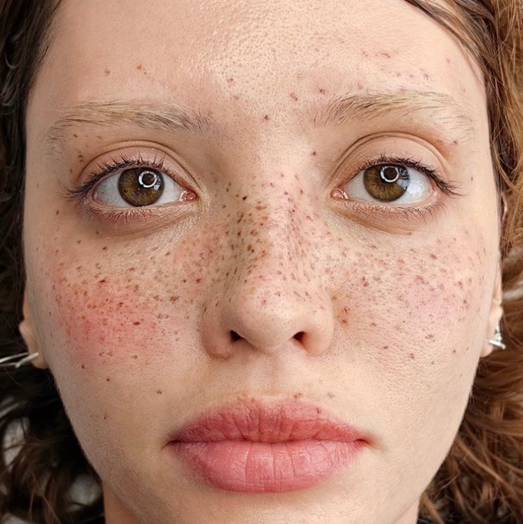 Freckle or mole