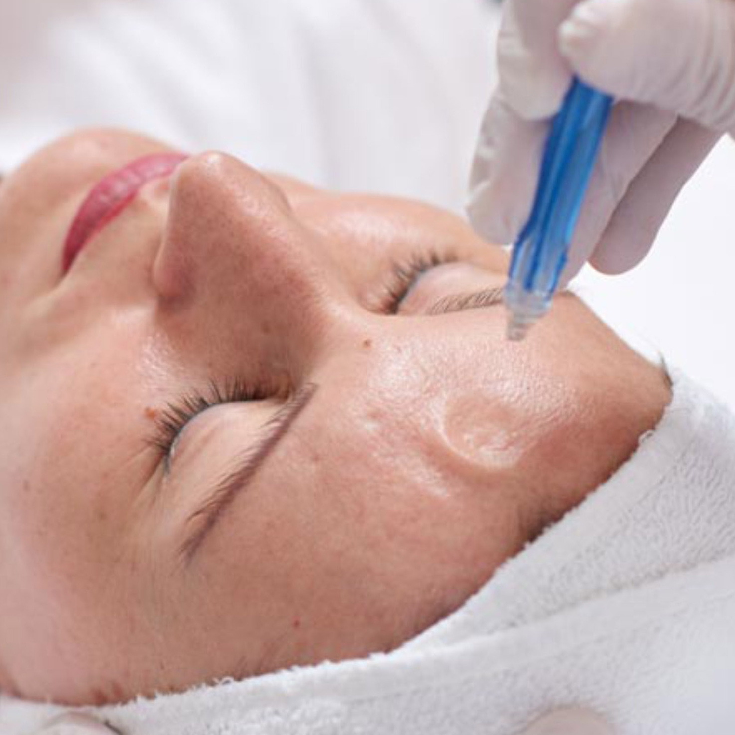 Безиньекционная мезотерапия лица