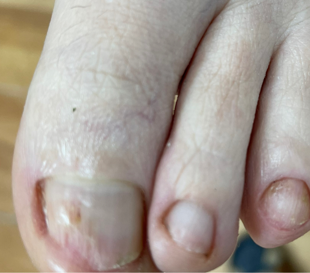 Зачистка онихолизиса 1/3 ногтя (единица)