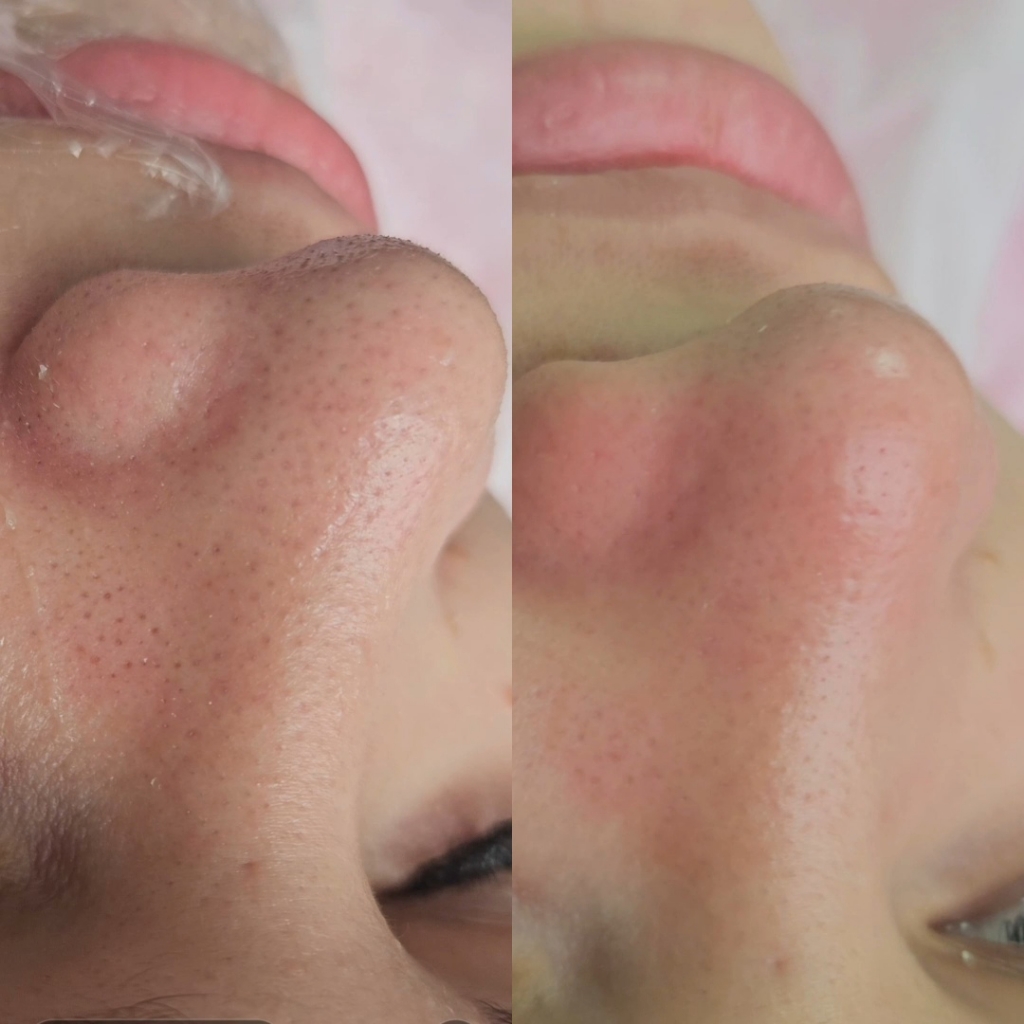 комбинированная (механическая + ультразвуковая) камедоны в 1 зоне