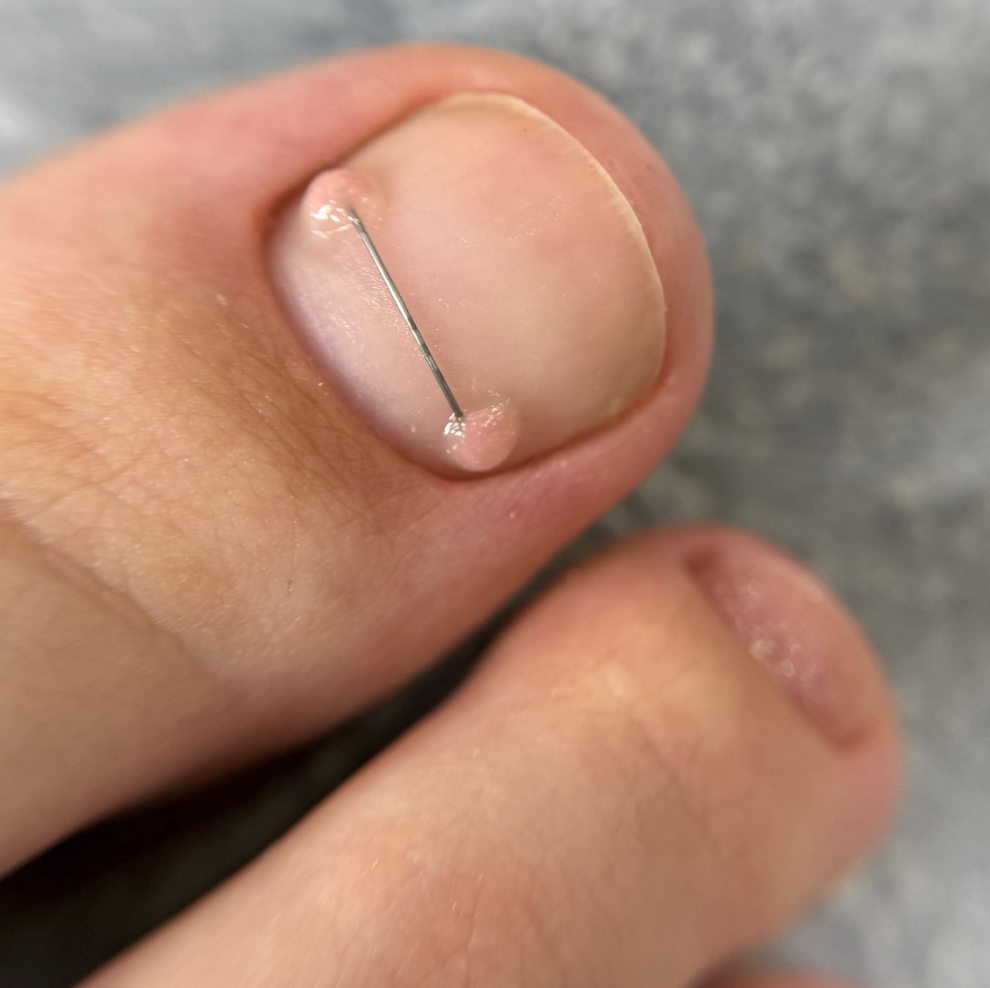 Коррекционная система «титановая нить»1шт