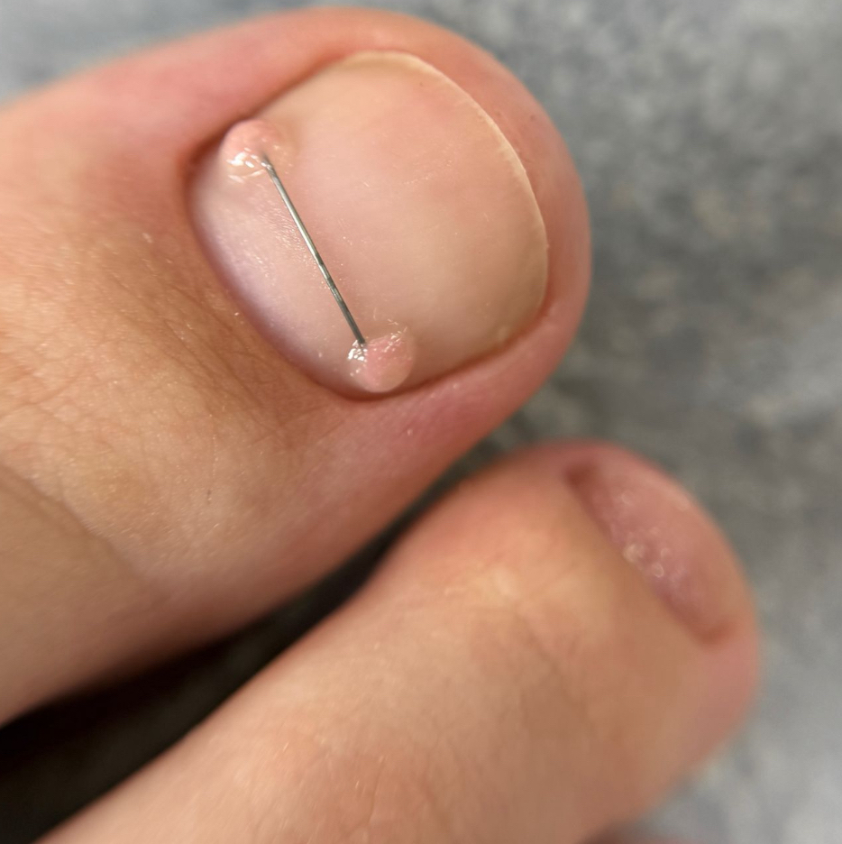 Установка второй коррекционной система «титановая нить» на 1 ноготь