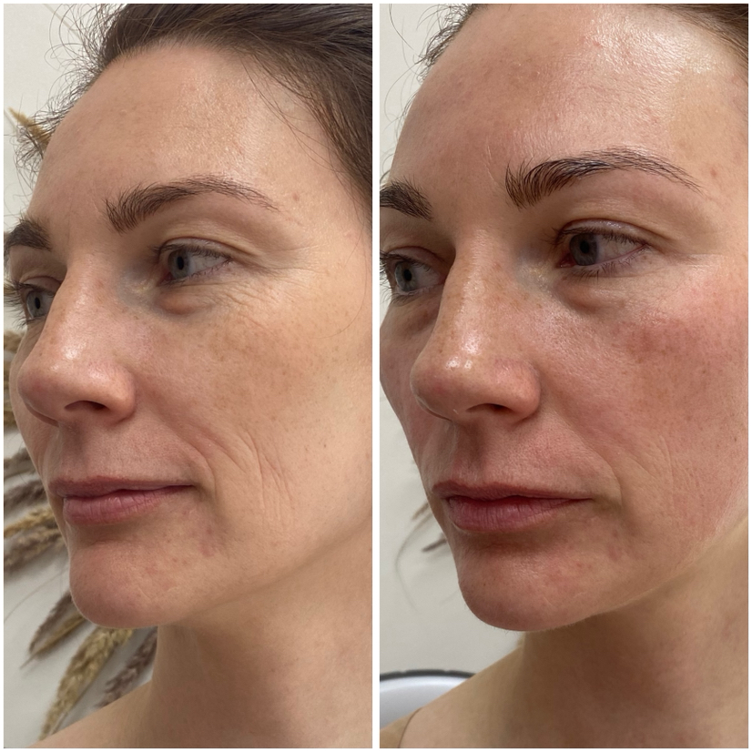 КОРРЕКТИРУЮЩИЙ миофасциальный массаж лица