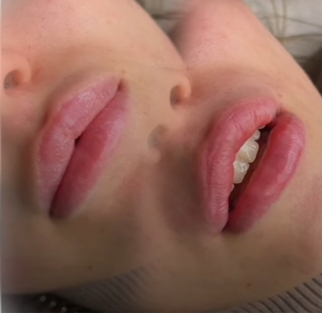 Удаление филлера из губ полное