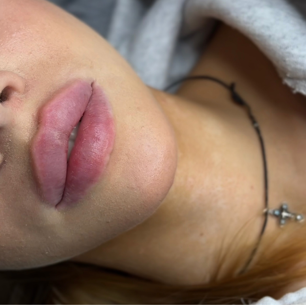 Коррекция остатками филлера при необходимости