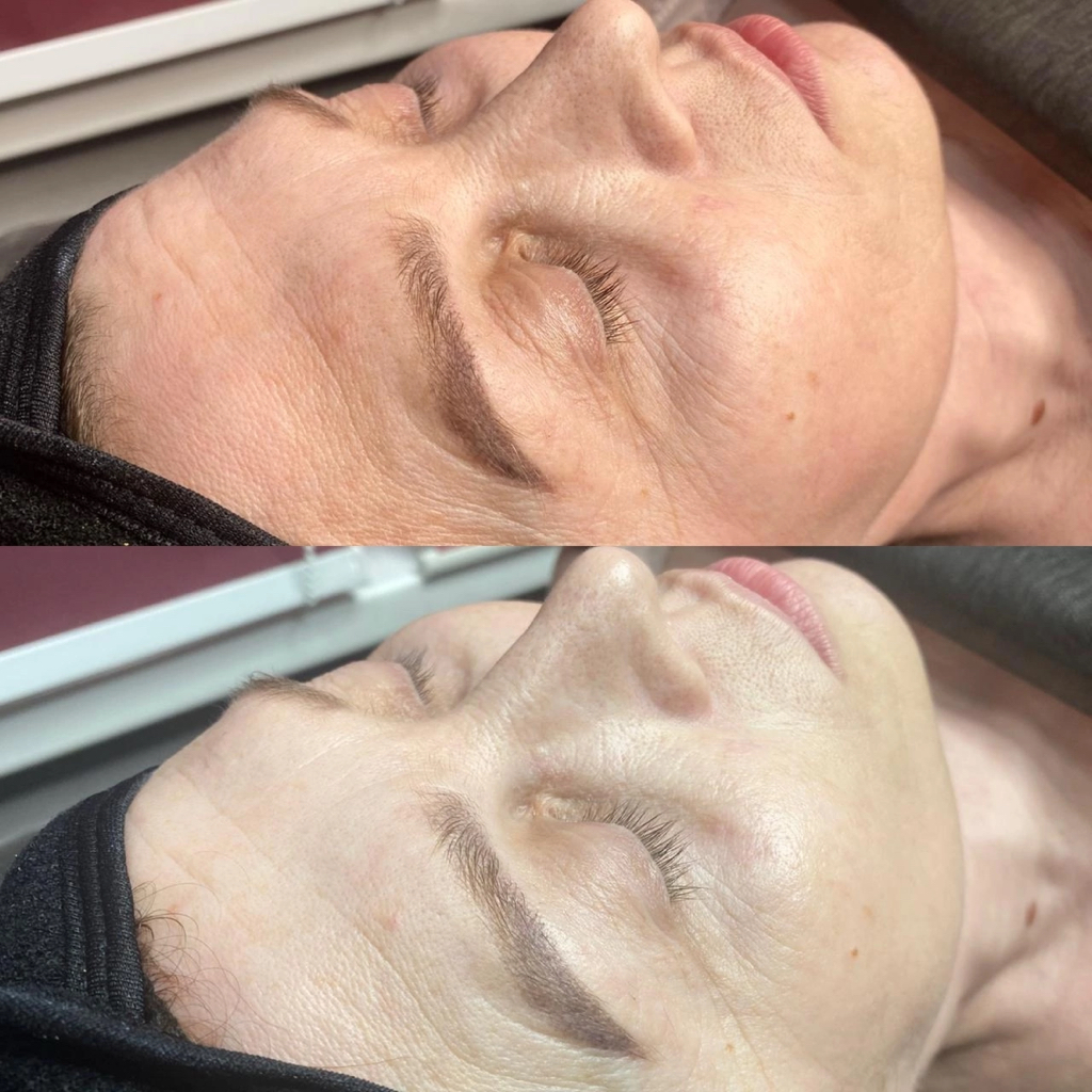 Карбокситерапия